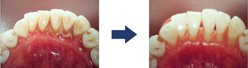写真：歯石除去の術前と術後